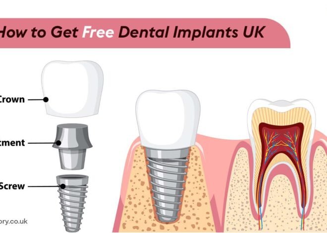 How To Get Free Dental Implants UK