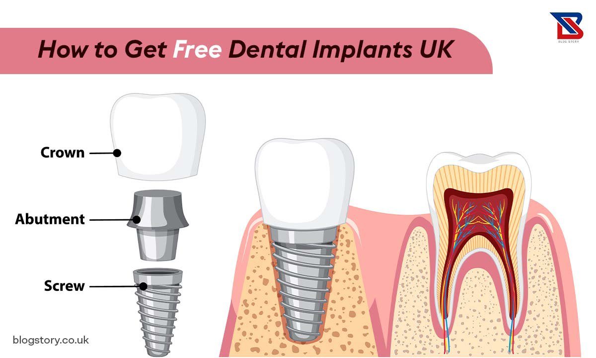 How To Get Free Dental Implants UK